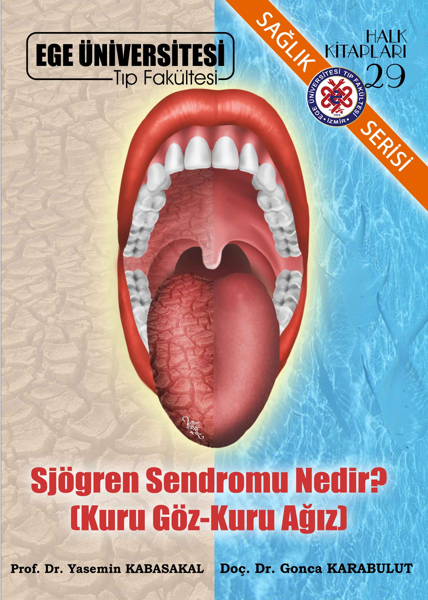 Sjögren Sendromu Nedir? (Kuru Göz-Kuru Ağız)