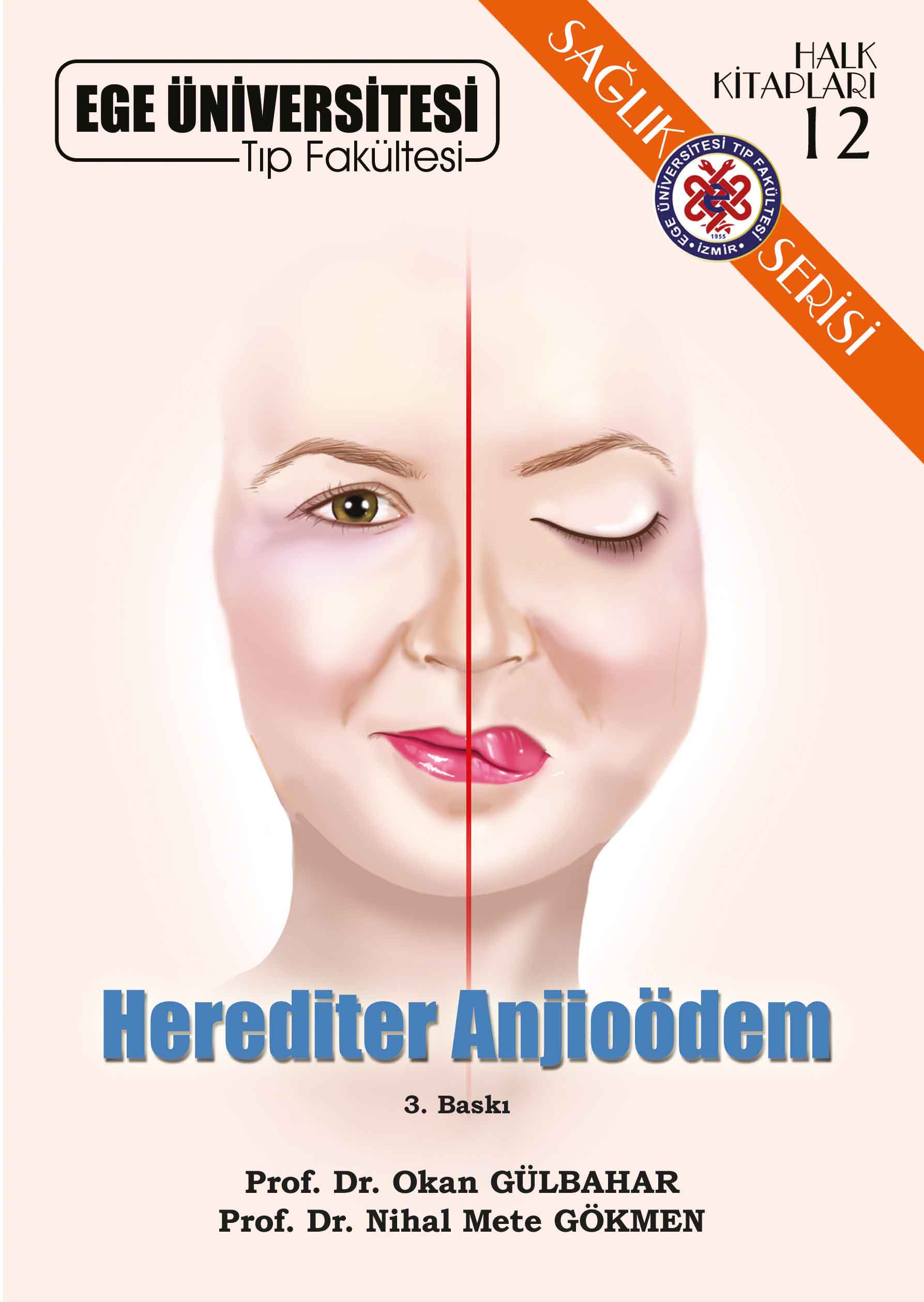 Herediter Anjioödem